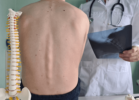 Skolyoz Tedavisinde Erken Müdahalenin Önemi